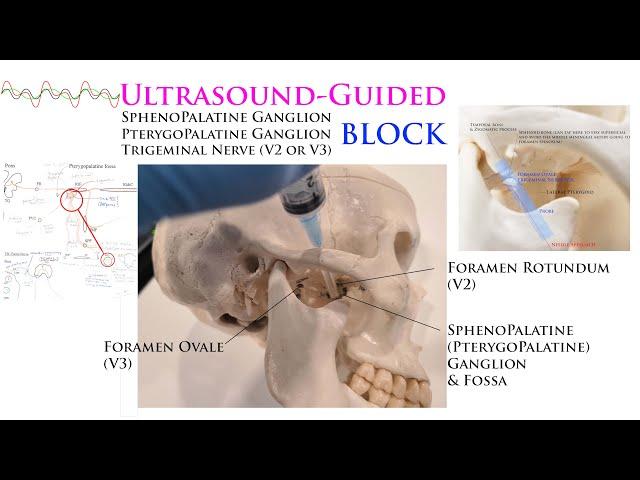 Ultrasound-Guided Sphenopalatine, Pterygopalatine, Trigeminal Nerve Gasserian Ganglion Blocks