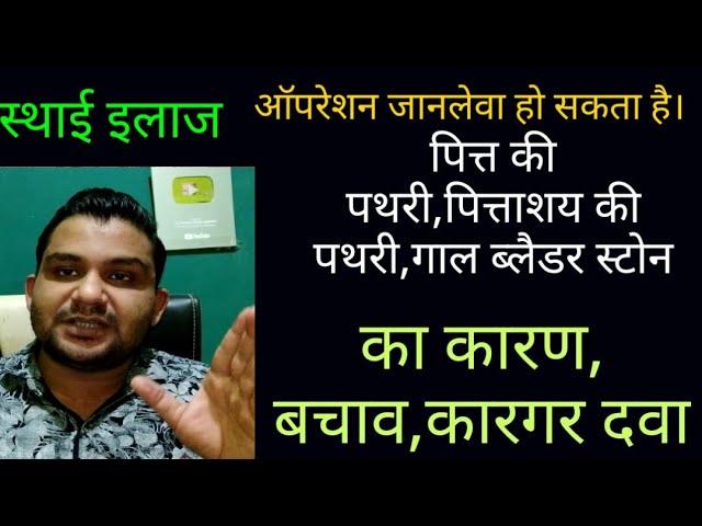 पित्ताशय की पथरी,पित्ते की पथरी,गॉल ब्लैडर स्टोन में क्या करें?क्या न करें?सटीक जानकारी|सटीक इलाज|