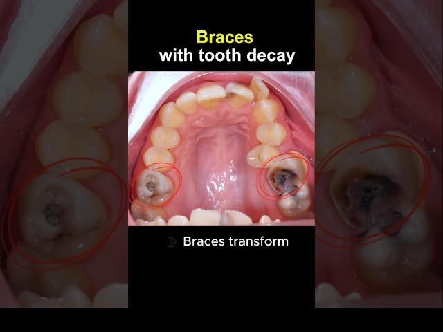 Braces for tooth decay #orthodontist #dentist #dentist #braces
