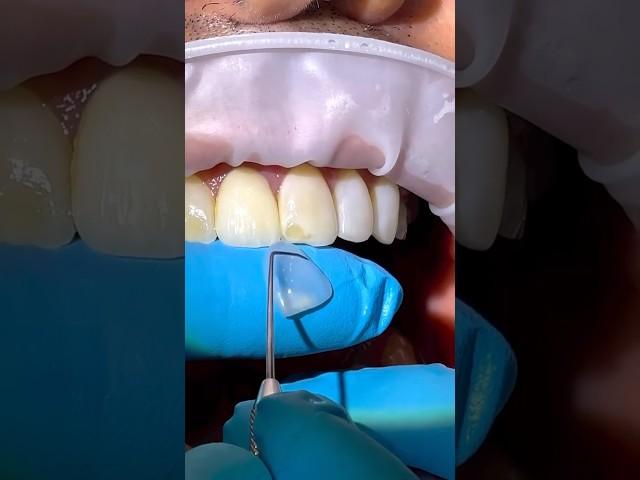 No-Prep Ceramic Veneer Repair: Part I #veneers #repairs #biomimeticdentistry