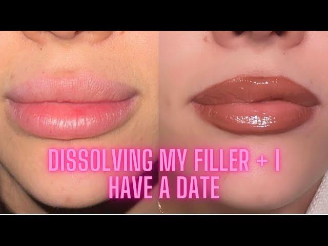 DISSOLVING MY LIP FILLER + MY DATE AT A 2 MICHELIN STAR RESTAURANT   | VLOG | HOLLY SCARFONE