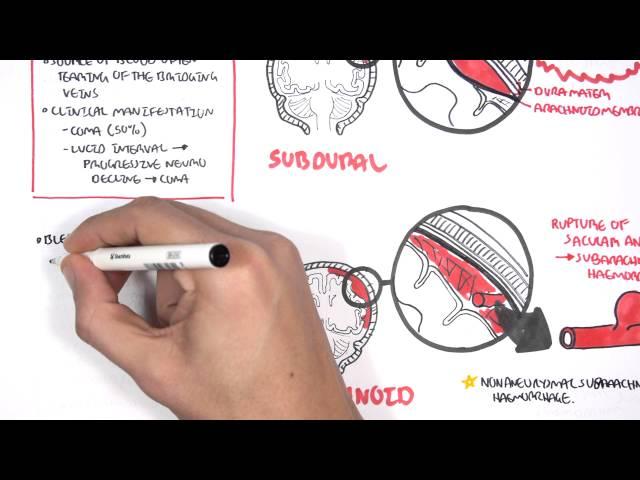 Intracranial Haemorrhage Types, signs and symptoms