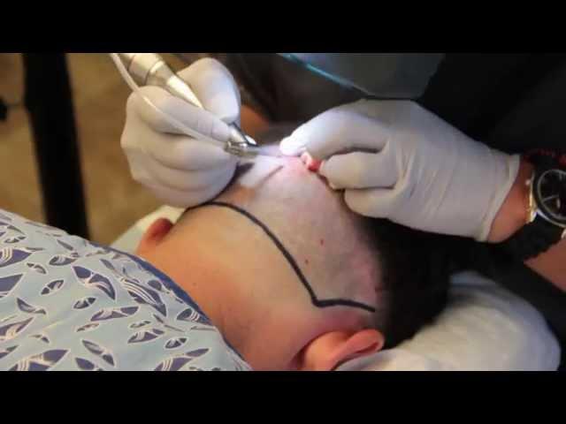 Neograft hair transplant procedure in Boise - Silk Touch Med Spa