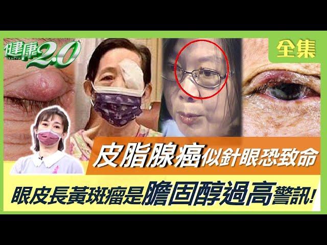 吳淑珍切除眼瞼惡性腫瘤！皮脂腺癌難痊癒 與針眼相似恐致命！眼皮長黃斑瘤 是膽固醇過高警訊！確診康復竟雙眼眼中風！冬天護眼防中風 暖胃木虌果料理上菜！  健康2.0 20221022 (完整版)