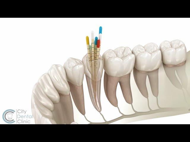 Endodontics | Root canal treatment | City Dental Clinic Bratislava