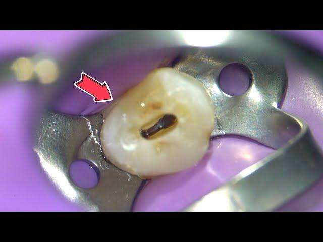 LIVE: Root Canal Procedure under the Microscope w/ Specialist