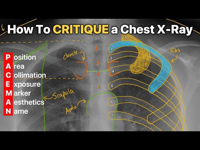 How To Critique a Chest X-Ray! [4 DIFFERENT EXAMPLES]