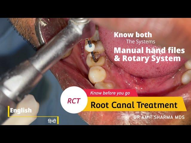 How Root canal  treatment / RCT is done ? Know both Manual and Rotary system