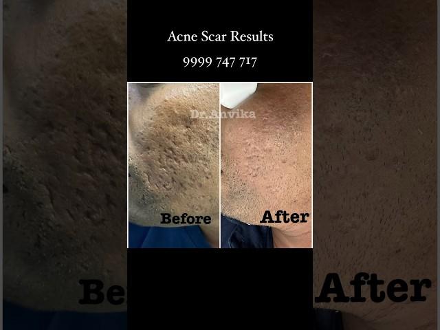 Acne Scars - Can be treated with lasers combination !!