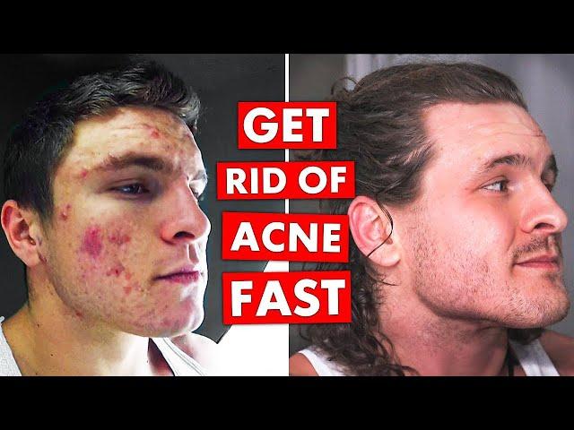 5 DO's & DON'TS To Get Rid of Acne FAST!