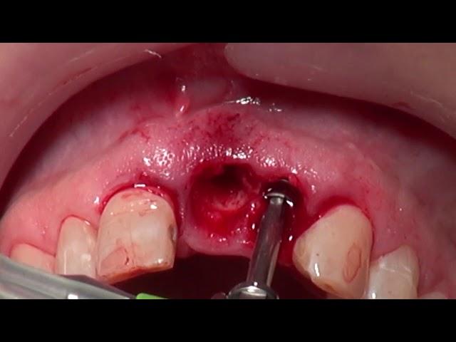 Immediate Implant Placement (Paltop)- Raptos, Osseoguard, Mucoderm and Provizionalisation