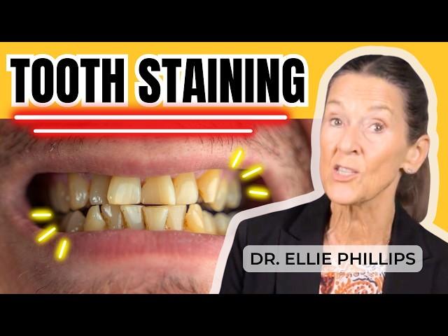 Why You Have Tooth Staining