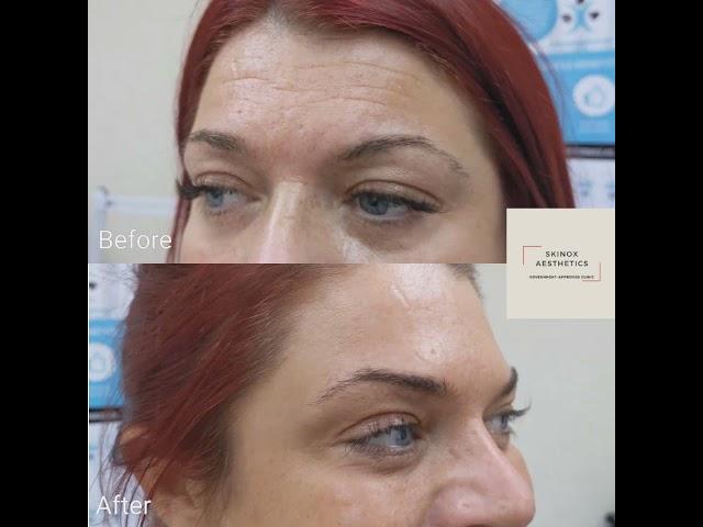 Anti-wrinkle treatment