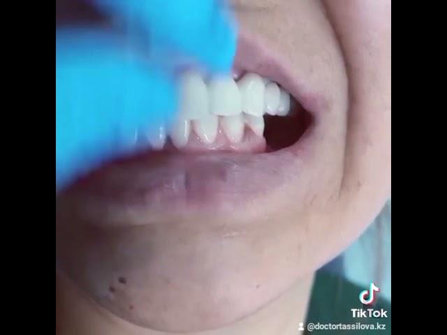 МЕТАЛЛОКЕРАМИЧЕСКИЕ КОРОНКИ by DOCTOR TASSILOVA ALMATYзапись через инстаграм:@tassiliva_clinic_kz