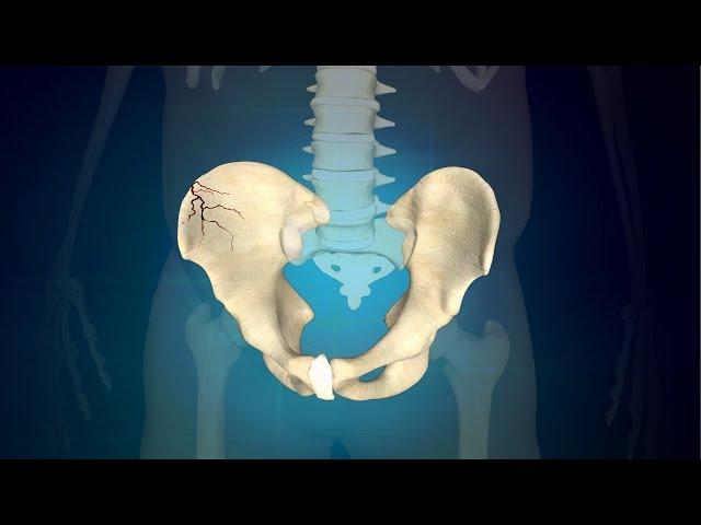 3 Simple Exercises for Pelvic Fracture to Regain Regular Function