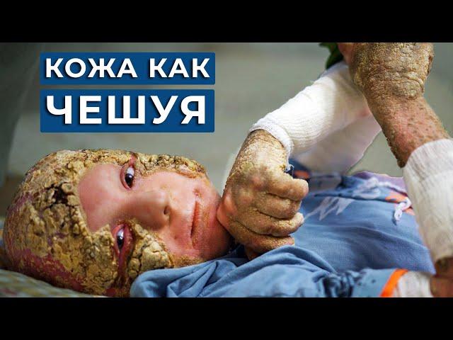 Мой сын словно ГНИЁТ ЗАЖИВО, "ЧЕШУЯ" вместо кожи / Синдром KID, Ихтиоз