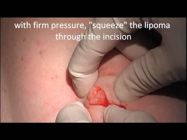 Lipoma Removal In Vivo