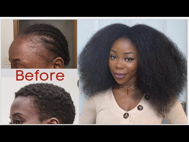 My natural hair journey. Hair loss, Balding, Damage and Regrow + pics and videos