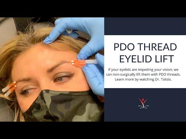 Non-Surgical Eyelid Lift with PDO Threads