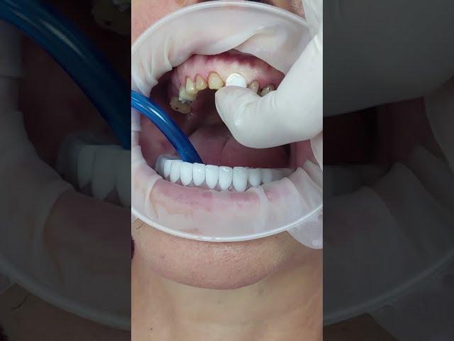 Temporary Cementation of Single Metal Ceramic Crowns #shorts