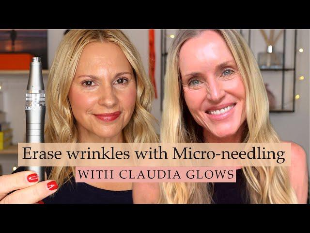 Medical Microneedling Doesn't Hurt! | Skin Obsessed Mary