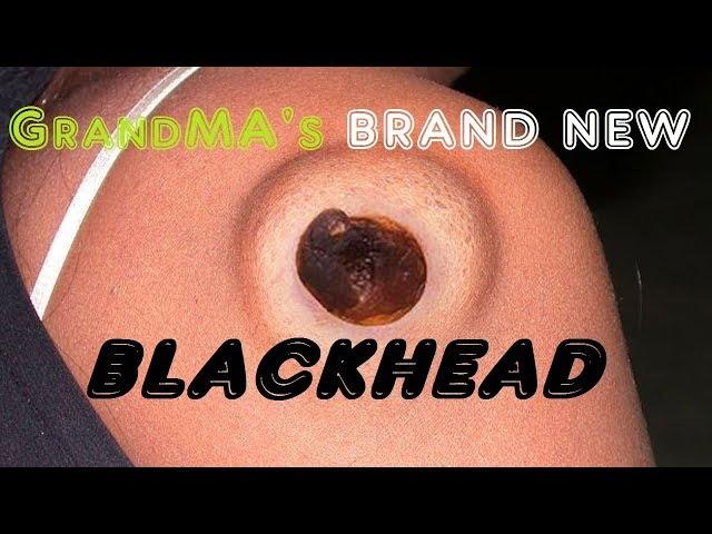 Grandma's brand new blackhead. Extravagant blackhead extraction.