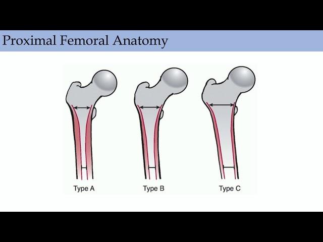 Primary Hip Replacement - ABOS Orthopedic Surgery Board Exam Review