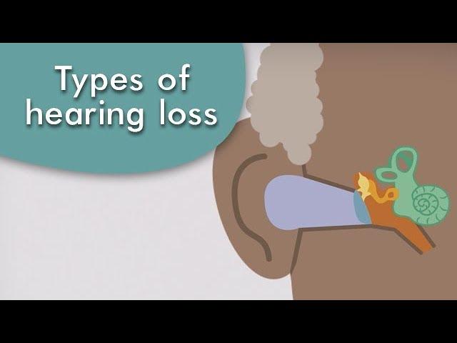 Types of hearing loss