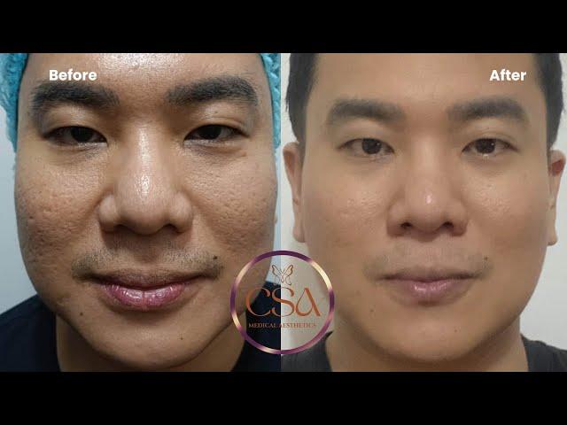 Acne scar management with Eladerm and skin booster