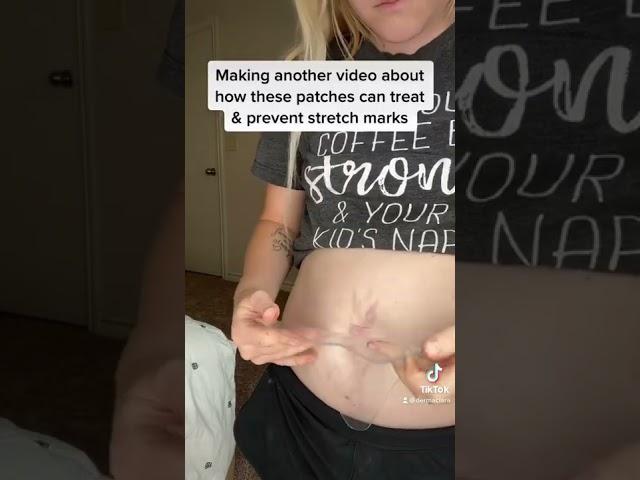 Silicone Patches to treat and prevent stretch marks 