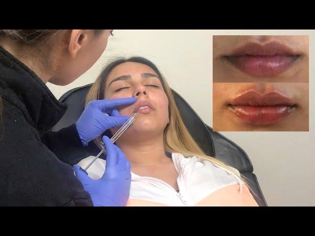 I GOT LIP FILLERS!? BEFORE AND AFTER | Brenda Huerta