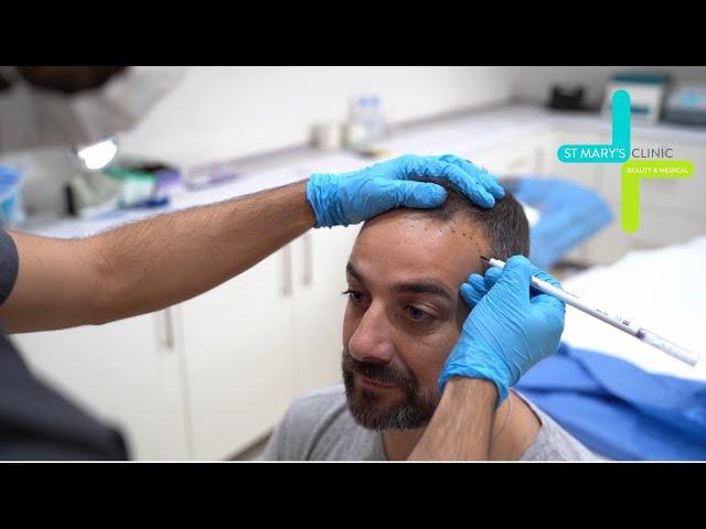 Experiencing the Hair Transplant Procedure | St Mary's Hair Clinic