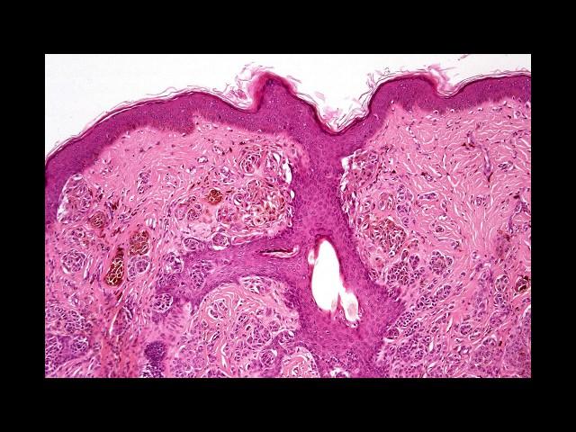 Recurrent nevus Phillip H McKee