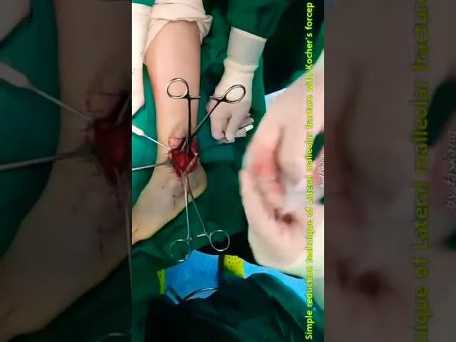 S6.Lateral malleolar fracture reduction technique, using with Kocher clamp (for Osteoporosis pts.)