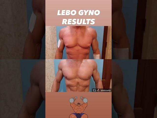 GYNECOMASTIA SURGERY RESULTS #beforeandafter #gynosurgeon #antiaging #transformation #aesthetic