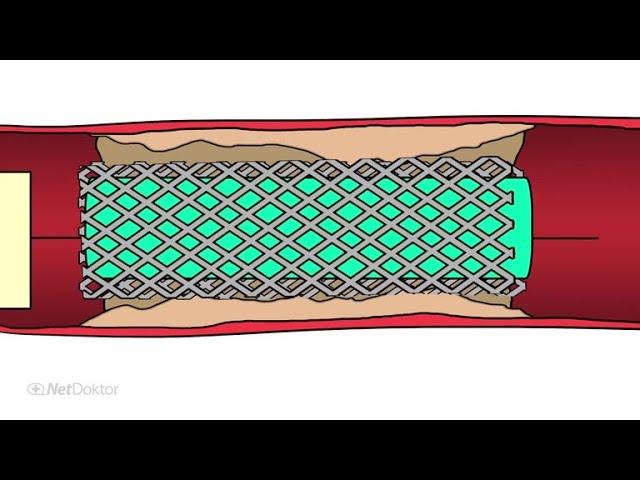 Stent: Das Metallgeflecht kann Leben retten - NetDoktor.de