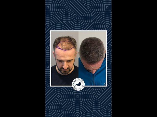 Hair Transplant Turkey - Jones's 9 Months Result