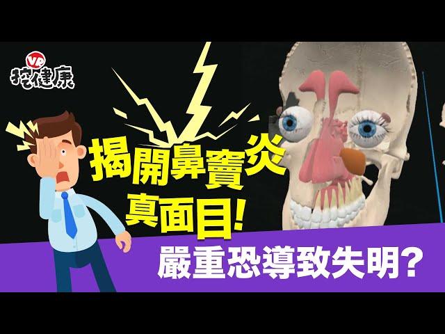 揭開 鼻竇炎 真面目！嚴重恐導致 失明 嗅覺失常 腦膜炎 ！自我診斷這樣看【VR挖健康】EP5