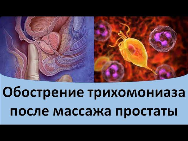 Обострение трихомониаза после массажа простаты