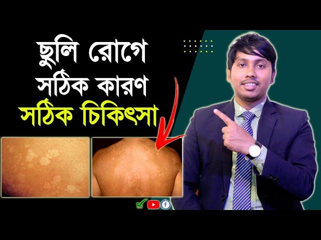 ছুলি রোগের চিকিৎসা | ছুলি দূর করার উপায় | ছলমের চিকিৎসা