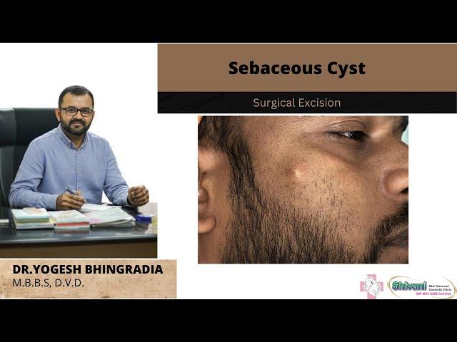 Sebaceous Cyst | Cyst removal by Surgical Excision | Scarless surgery | Dr. Yogesh Bhingradia