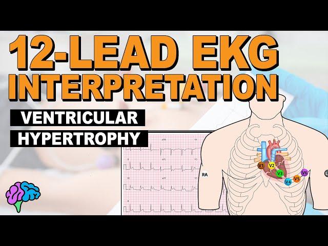 Ventricular Hypertrophy (LVH & RVH) on 12-Lead EKG