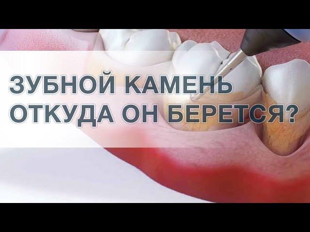 Что такое зубной камень? Нужно ли удалять камень?