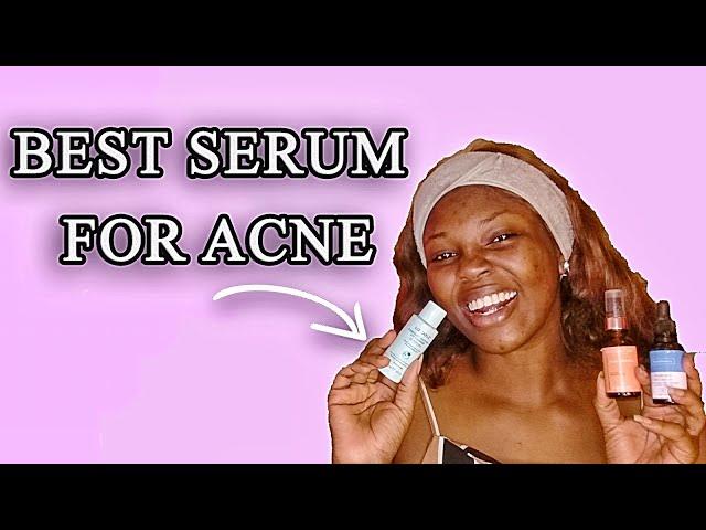Best Toners & serums for Acne Prone Dark skin @PoirePosh