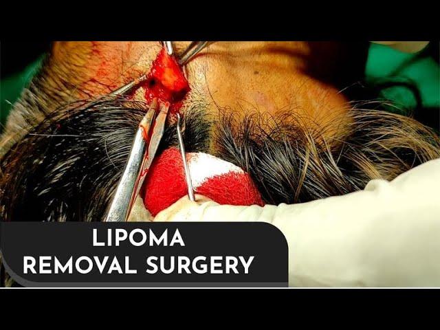 Forehead Lipoma Removal under local anesthesia by Dr. Prashant Yadav