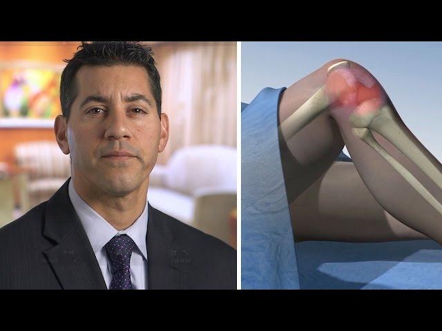 Bone Marrow Stem Cell Treatment (BMAC) for Knee Osteoarthritis - Mayo Clinic