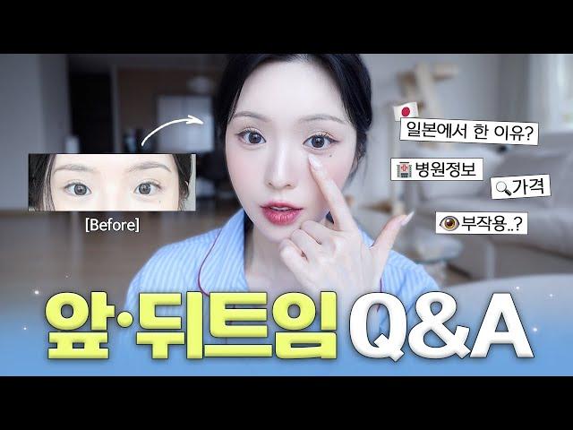 Why Did You Get Inner Corner Eye Surgery in Japan? Q&A