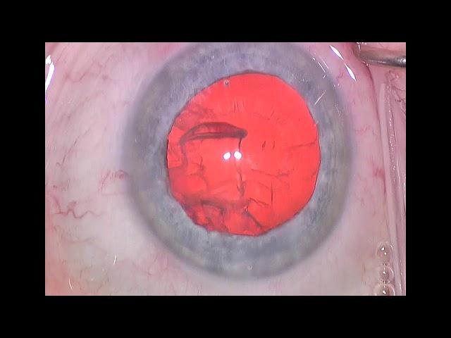 Dr. Steve Khachikian - Routine Cataract Surgery - Black Hills Eye Institute