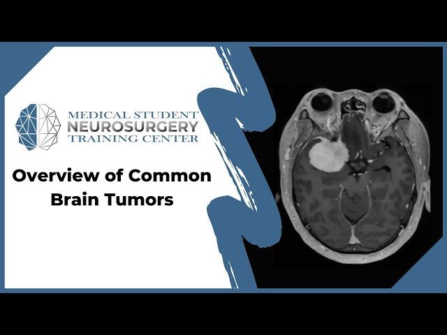 Overview of Common Brain Tumors