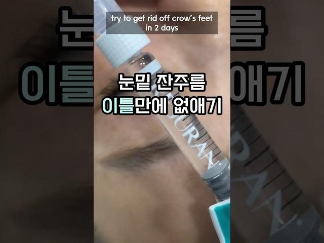 눈밑주름 눈가주름 없애기‼️ #리쥬란 실제 시술 영상